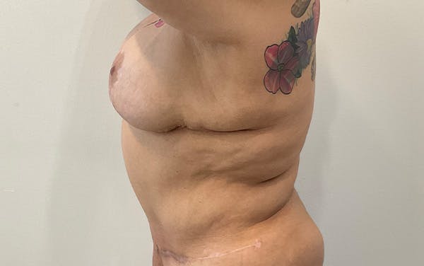 Tummy Tuck Before & After Gallery - Patient 253676 - Image 10