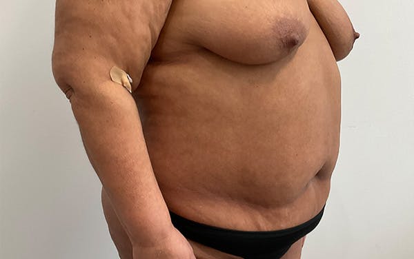 Tummy Tuck Before & After Gallery - Patient 253676 - Image 3
