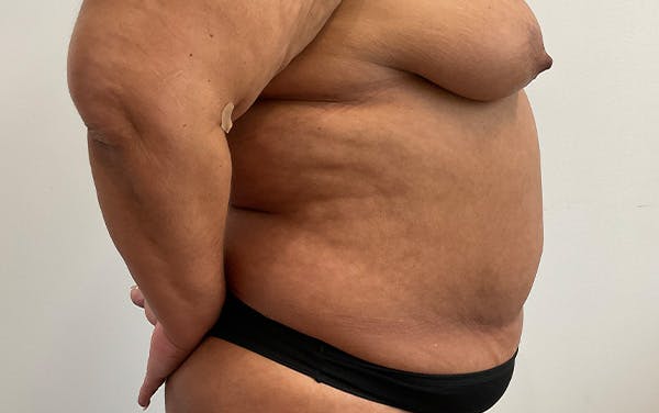 Tummy Tuck Before & After Gallery - Patient 253676 - Image 5