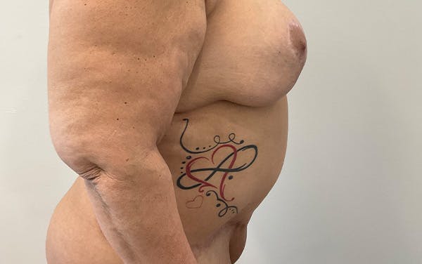 Tummy Tuck Before & After Gallery - Patient 253676 - Image 6