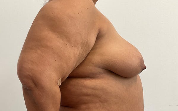 Breast Augmentation Before & After Gallery - Patient 136392 - Image 5