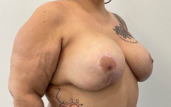 Breast Augmentation Before & After Gallery - Patient 136392 - Image 4