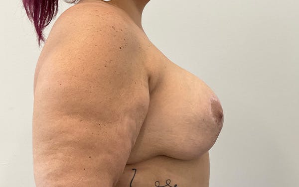 Breast Augmentation Before & After Gallery - Patient 136392 - Image 6