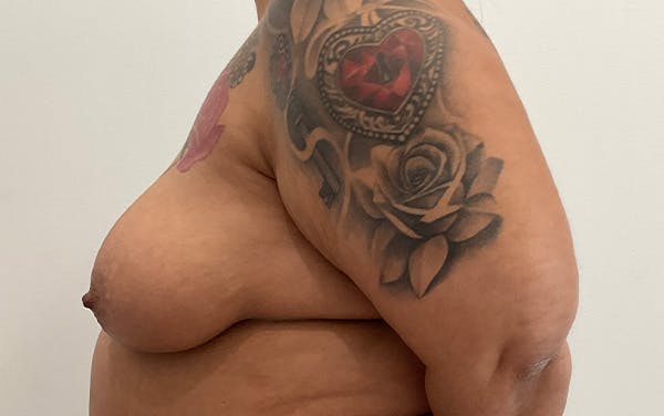 Breast Augmentation Before & After Gallery - Patient 136392 - Image 9