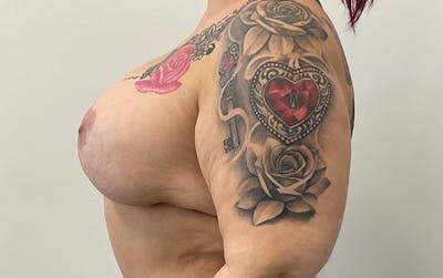 Breast Augmentation Before & After Gallery - Patient 136392 - Image 10