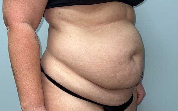 Tummy Tuck Before & After Gallery - Patient 353414 - Image 3