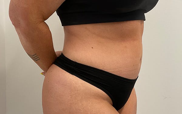 Tummy Tuck Before & After Gallery - Patient 353414 - Image 4