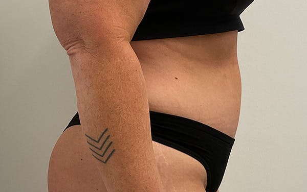 Tummy Tuck Before & After Gallery - Patient 353414 - Image 6