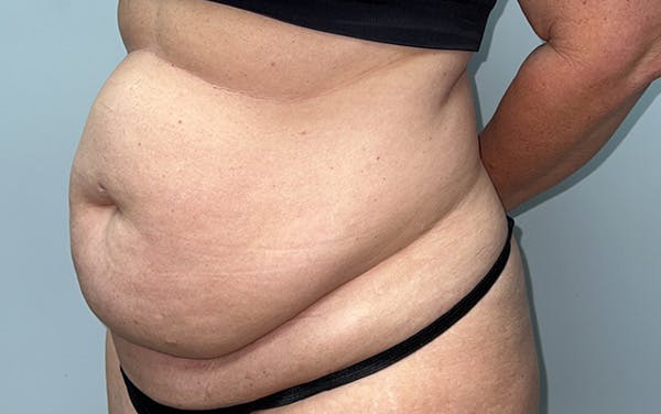 Tummy Tuck Before & After Gallery - Patient 353414 - Image 7