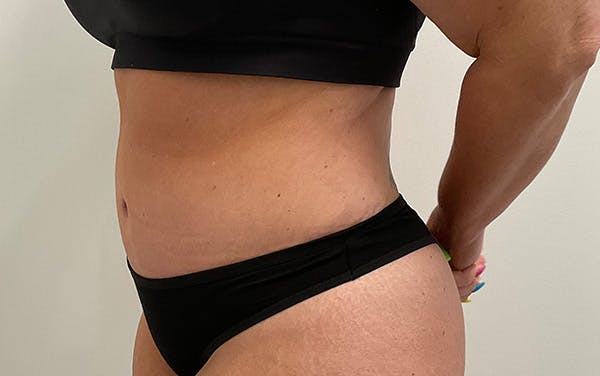 Tummy Tuck Before & After Gallery - Patient 353414 - Image 8