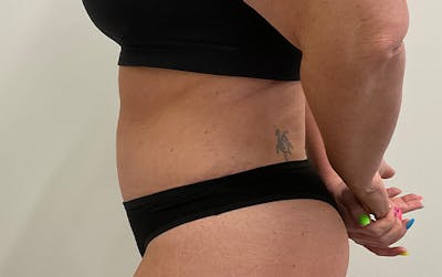 Tummy Tuck Before & After Gallery - Patient 353414 - Image 10