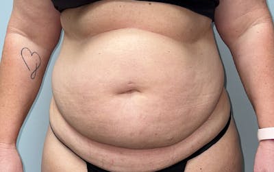 Tummy Tuck Before & After Gallery - Patient 353414 - Image 1