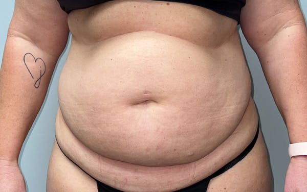 Tummy Tuck Before & After Gallery - Patient 353414 - Image 1