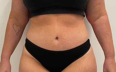 Tummy Tuck Before & After Gallery - Patient 353414 - Image 2