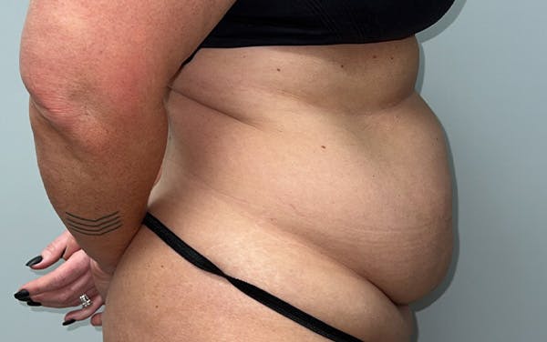Tummy Tuck Before & After Gallery - Patient 353414 - Image 5