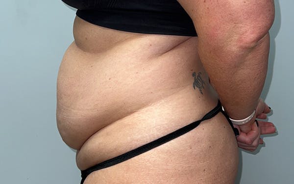 Tummy Tuck Before & After Gallery - Patient 353414 - Image 9