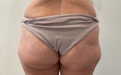 Butt Lift Before & After Gallery - Patient 361484 - Image 1