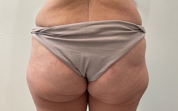 Tummy Tuck Before & After Gallery - Patient 111403 - Image 3