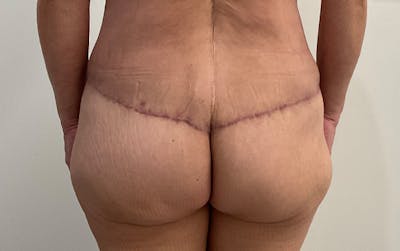 Butt Lift Before & After Gallery - Patient 361484 - Image 2