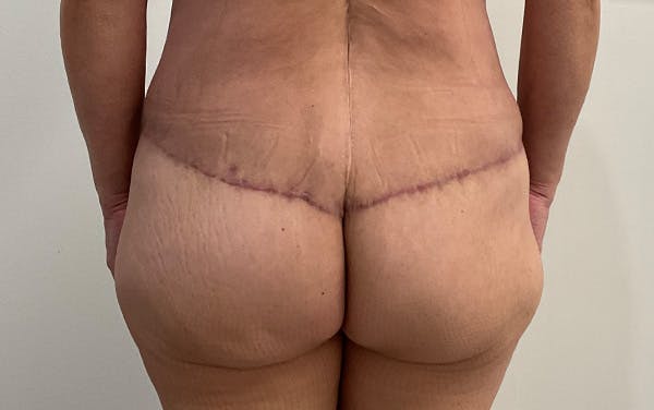 Tummy Tuck Before & After Gallery - Patient 111403 - Image 4