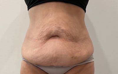Tummy Tuck Before & After Gallery - Patient 111403 - Image 1