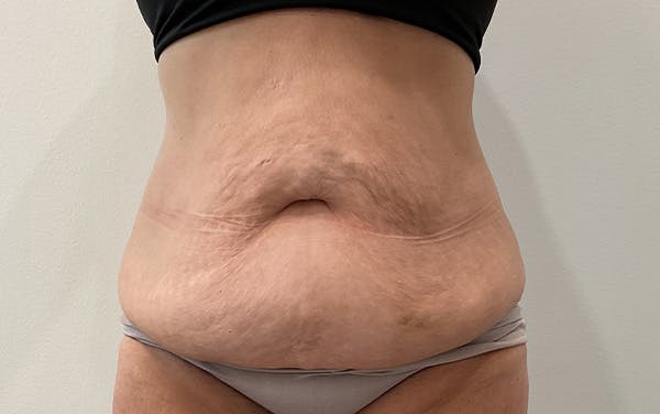 Tummy Tuck Before & After Gallery - Patient 111403 - Image 1