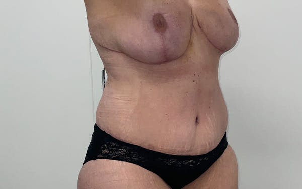 Tummy Tuck Before & After Gallery - Patient 150835 - Image 4