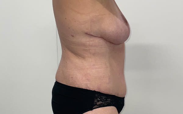 Tummy Tuck Before & After Gallery - Patient 150835 - Image 6