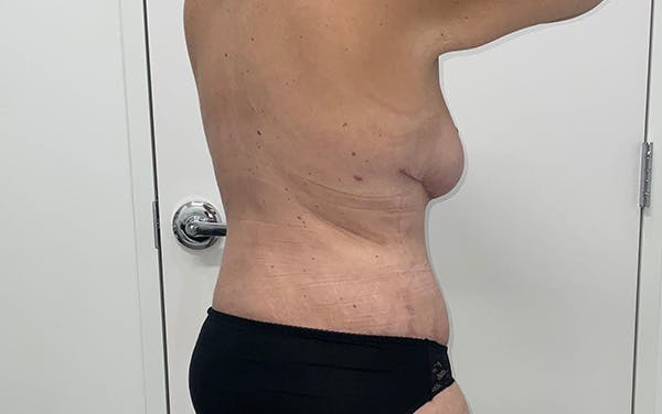 Tummy Tuck Before & After Gallery - Patient 150835 - Image 8