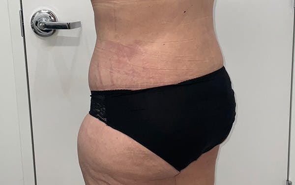Tummy Tuck Before & After Gallery - Patient 150835 - Image 14
