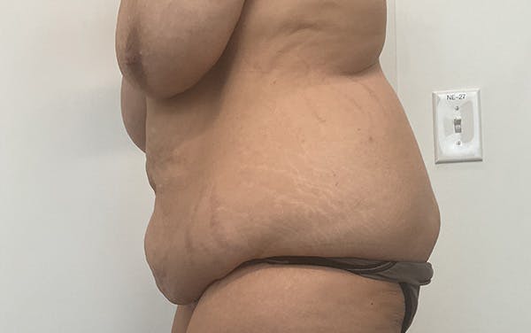 Tummy Tuck Before & After Gallery - Patient 150835 - Image 15