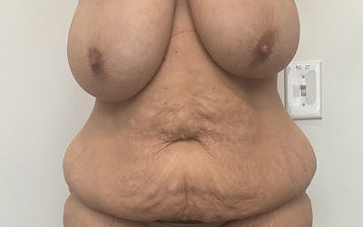 Tummy Tuck Before & After Gallery - Patient 150835 - Image 1