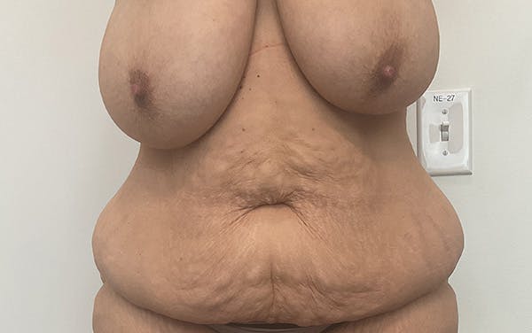 Tummy Tuck Before & After Gallery - Patient 150835 - Image 1