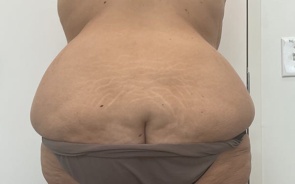 Tummy Tuck Before & After Gallery - Patient 150835 - Image 9