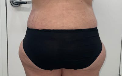 Tummy Tuck Before & After Gallery - Patient 150835 - Image 10