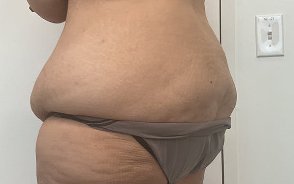 Tummy Tuck Before & After Gallery - Patient 150835 - Image 13