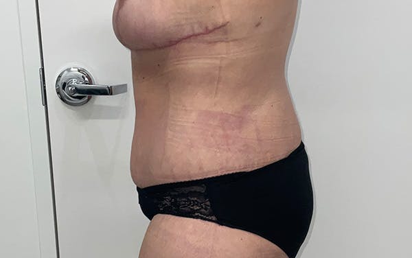 Tummy Tuck Before & After Gallery - Patient 150835 - Image 16