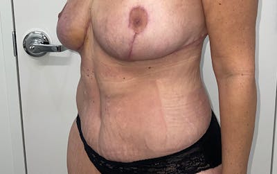 Tummy Tuck Before & After Gallery - Patient 150835 - Image 12
