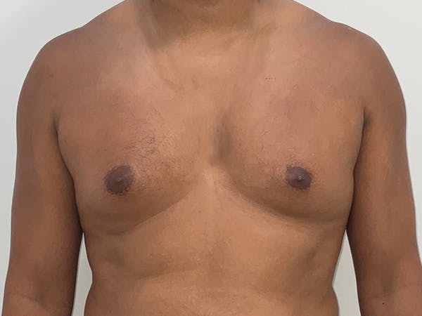 Gynecomastia Before & After Gallery - Patient 772682 - Image 1