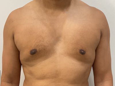 Gynecomastia Before & After Gallery - Patient 772682 - Image 2