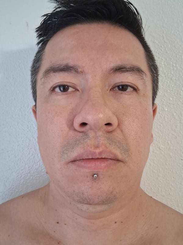 Upper Blepharoplasty Before & After Gallery - Patient 377130 - Image 1