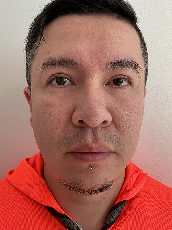 Upper Blepharoplasty Before & After Gallery - Patient 377130 - Image 2