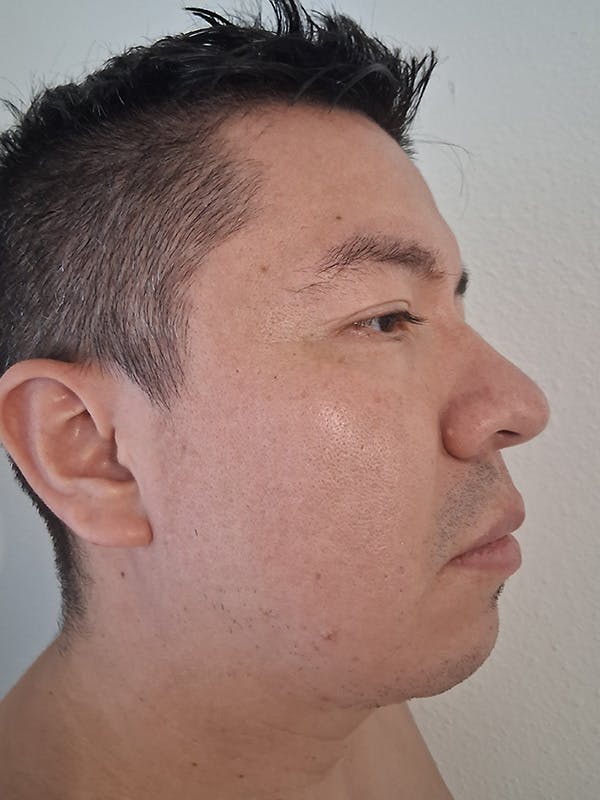 Upper Blepharoplasty Before & After Gallery - Patient 377130 - Image 4