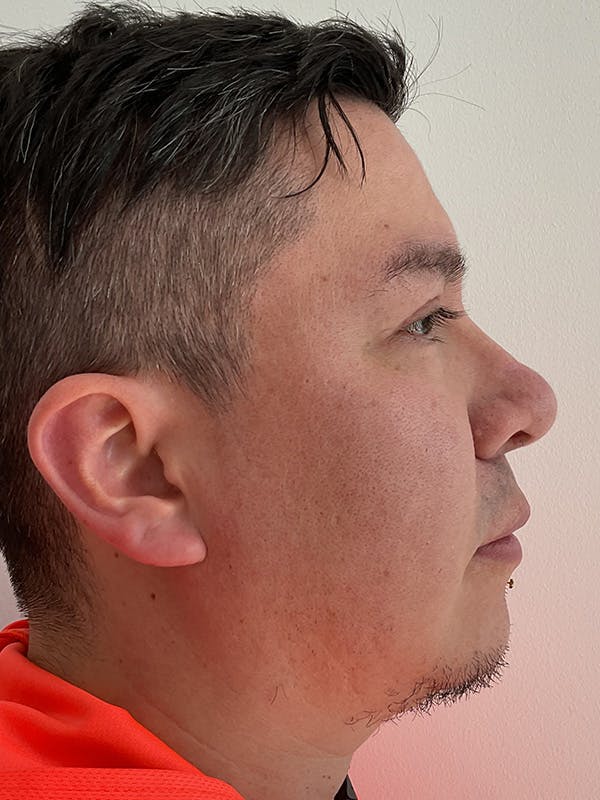 Upper Blepharoplasty Before & After Gallery - Patient 377130 - Image 3