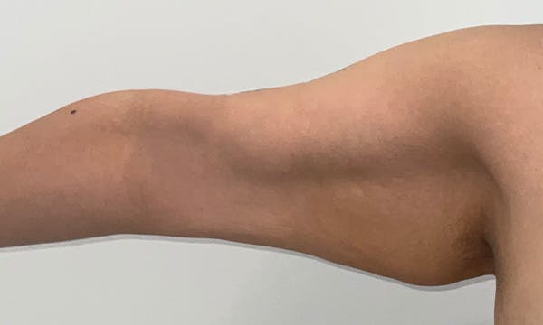 Arm Lift Before & After Gallery - Patient 103220 - Image 3
