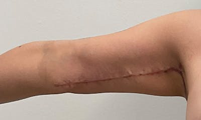 Arm Lift Before & After Gallery - Patient 103220 - Image 4