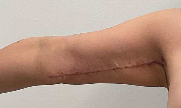 Arm Lift Before & After Gallery - Patient 103220 - Image 4