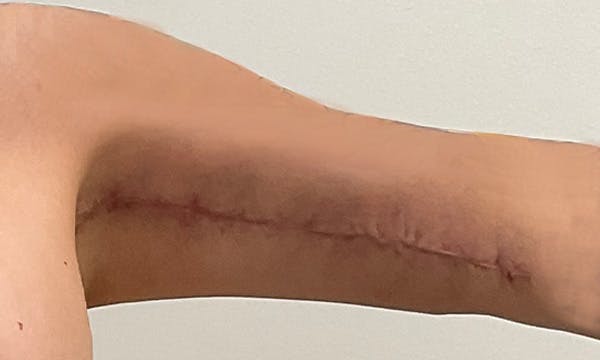 Arm Lift Before & After Gallery - Patient 103220 - Image 2