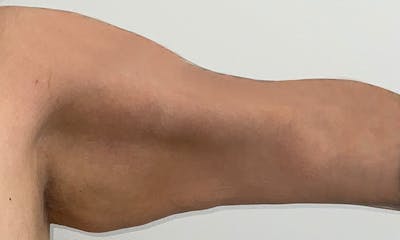 Arm Lift Before & After Gallery - Patient 103220 - Image 1