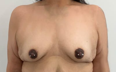 Breast Lift Before & After Gallery - Patient 396613 - Image 1
